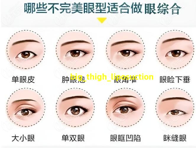 大腿抽脂术后恢复
