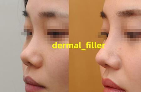 dermal filler