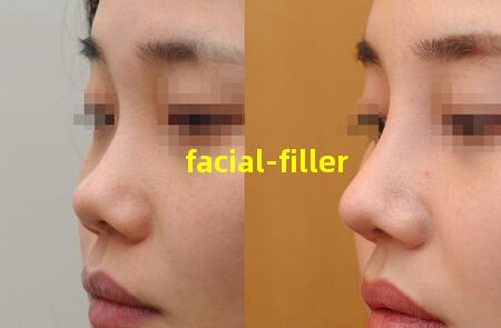 Facial Filler