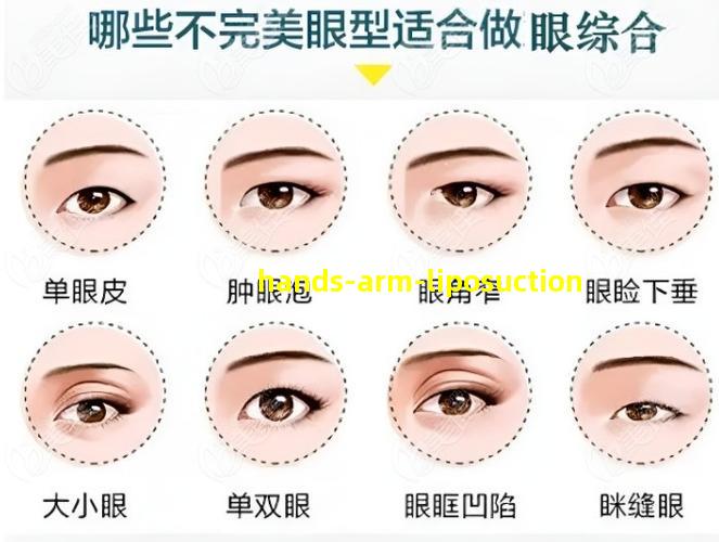 Hand Arm Liposuction Picture