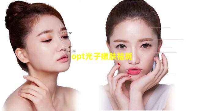 opt光子嫩肤祛斑