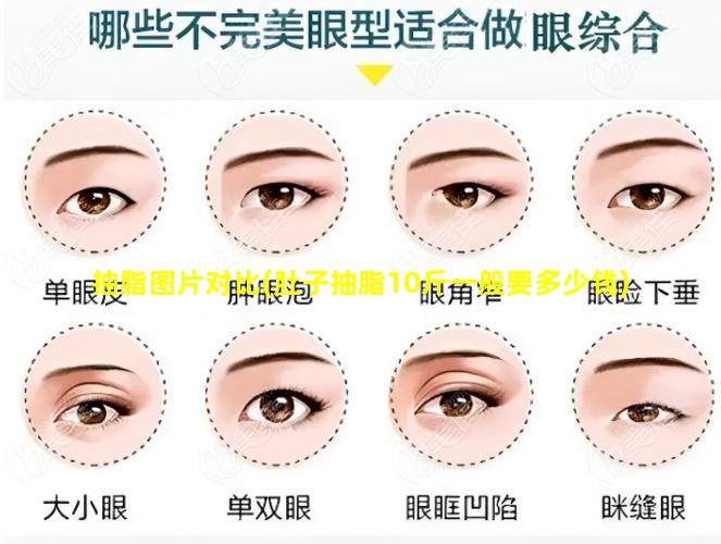 抽脂图片对比(肚子抽脂10斤一般要多少钱)