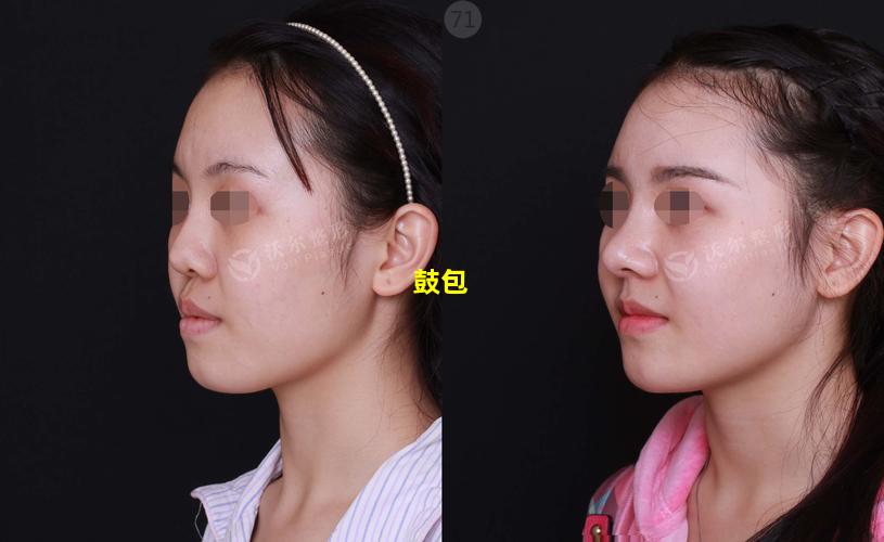 玻尿酸隆鼻眉心出现鼓包图片